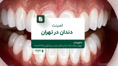 لمینت دندان در تهران