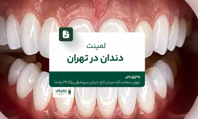 لمینت دندان در تهران