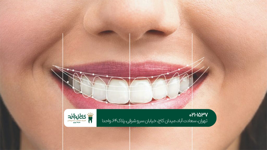 لمینت