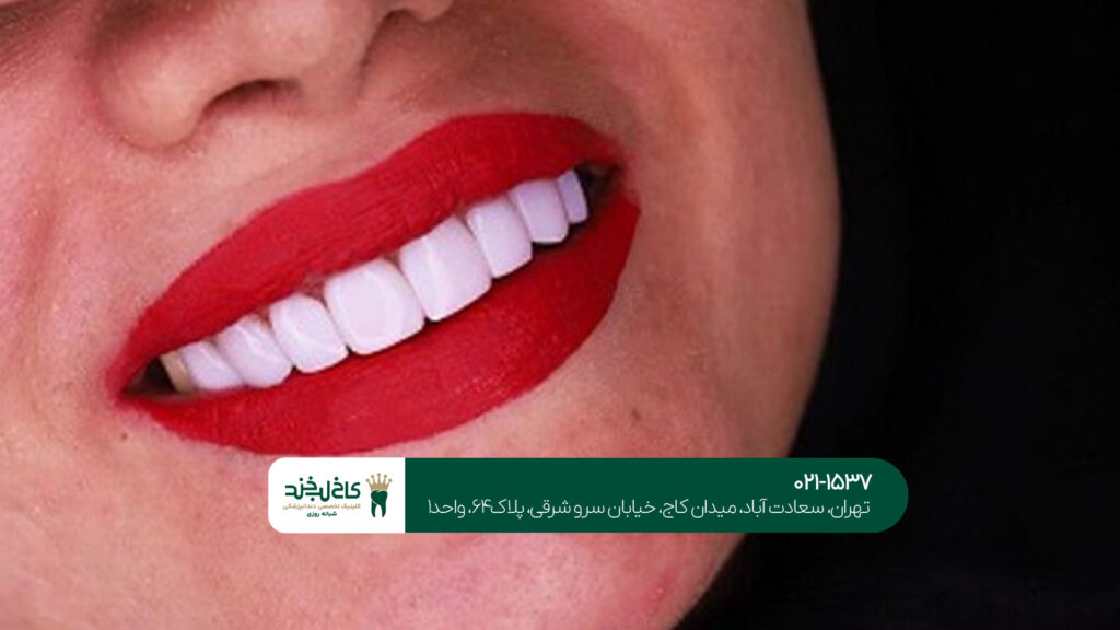 لمینت دندان